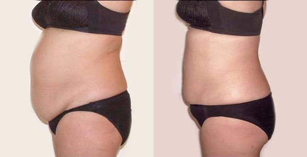 Liposuction Procedures