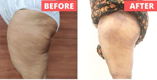 Liposuction Procedures