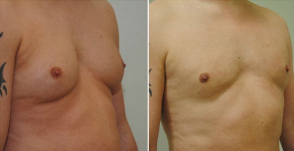 Liposuction Procedures
