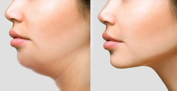 Liposuction Procedures