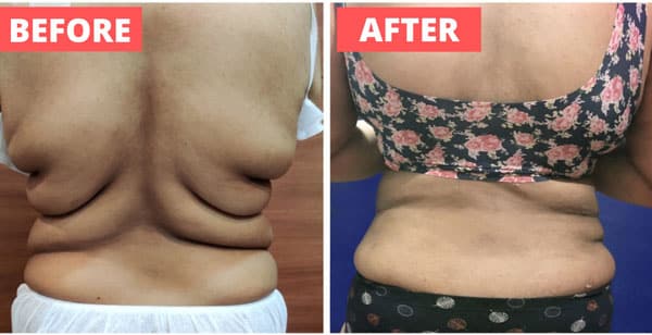 Liposuction Procedures