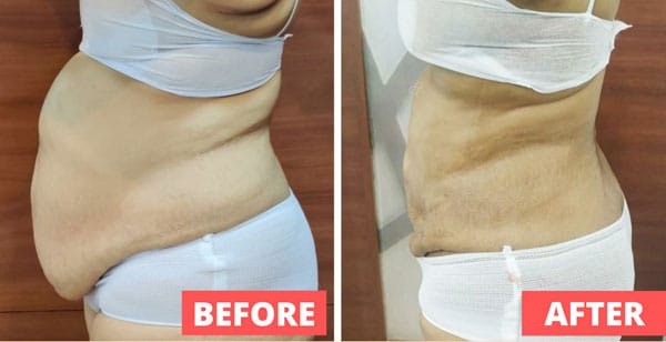 Liposuction Procedures