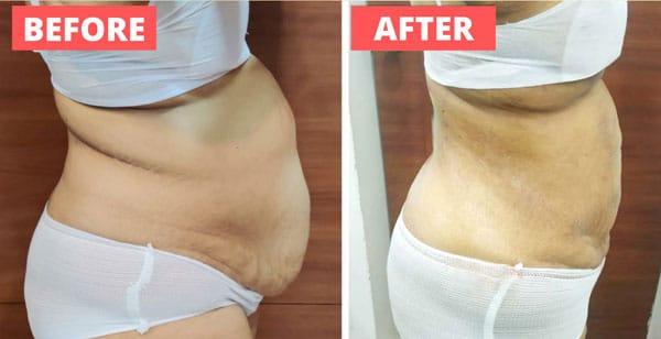 Liposuction Procedures