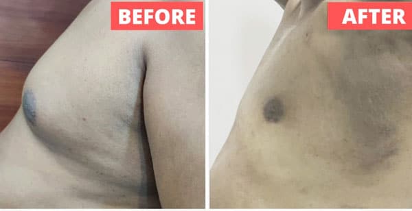 Liposuction Procedures