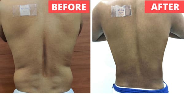 Liposuction Procedures