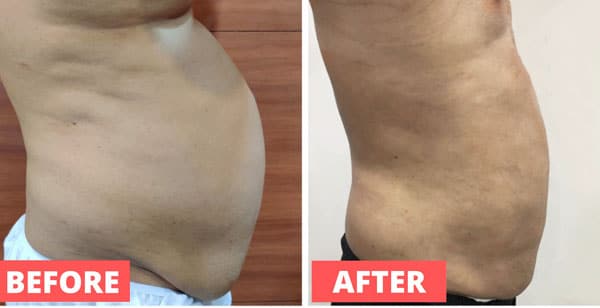 Liposuction Procedures