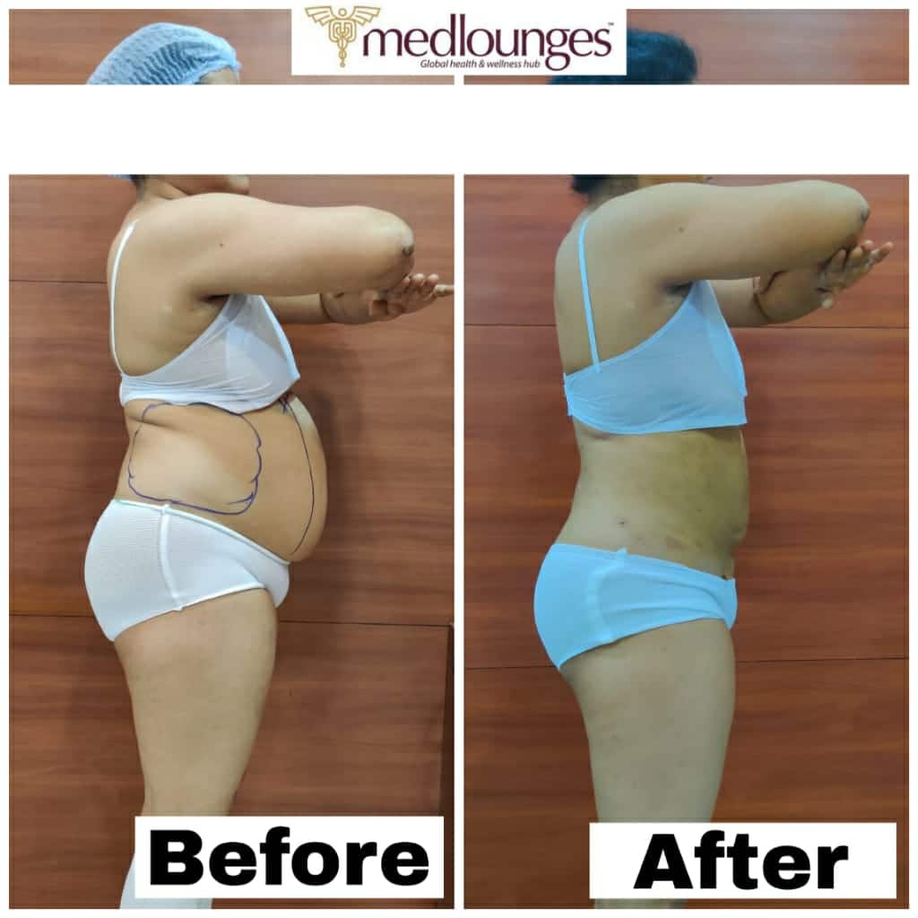 Liposuction Procedures