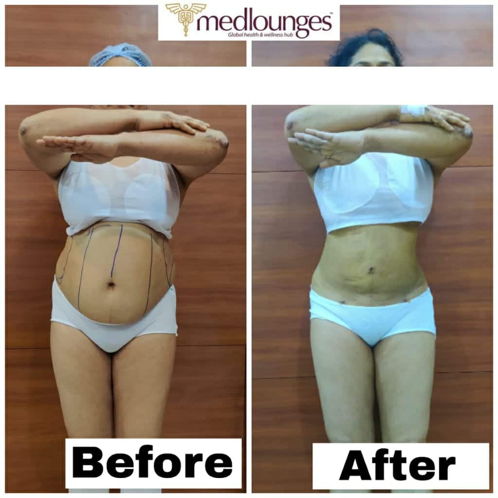 Liposuction Procedures
