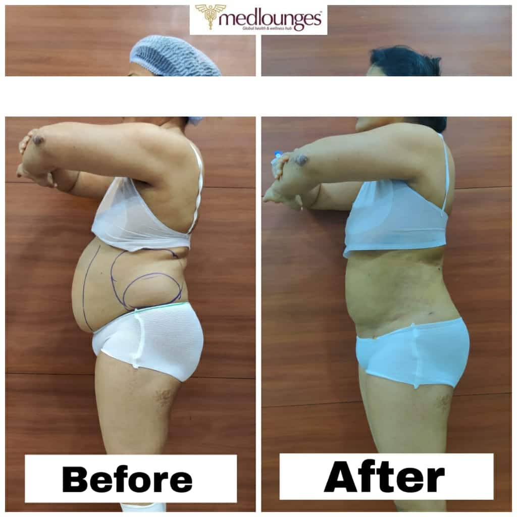 Liposuction Procedures