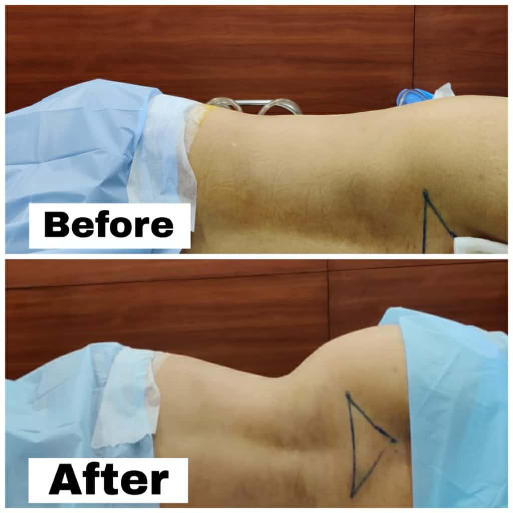 Liposuction Procedures