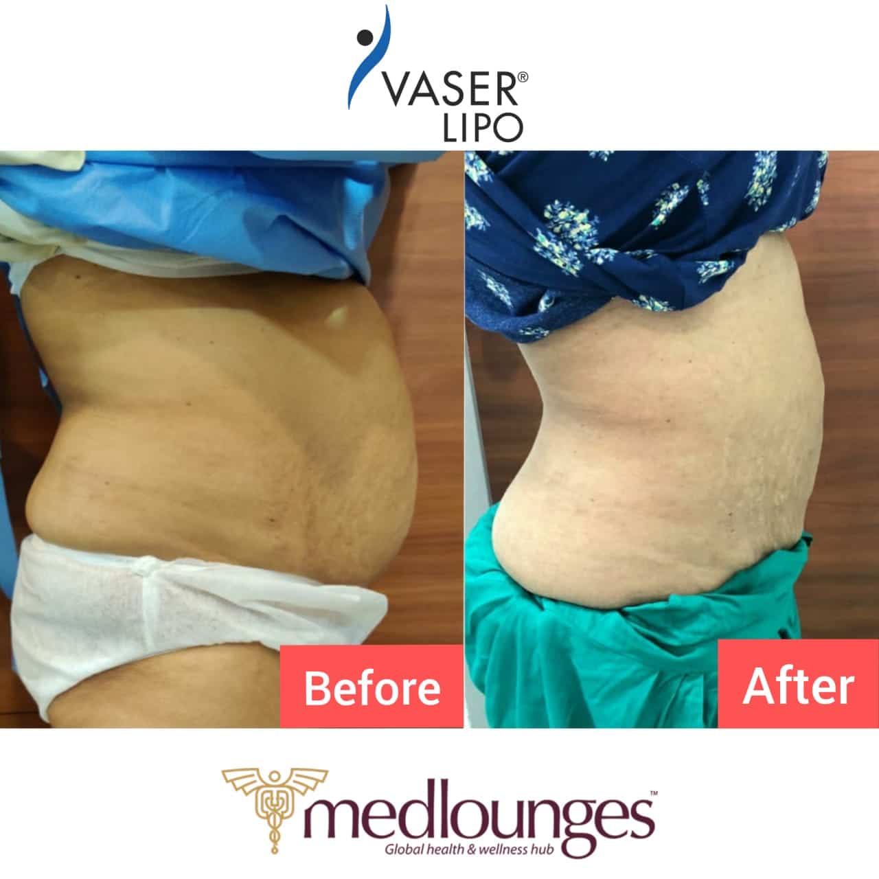 Liposuction Procedures