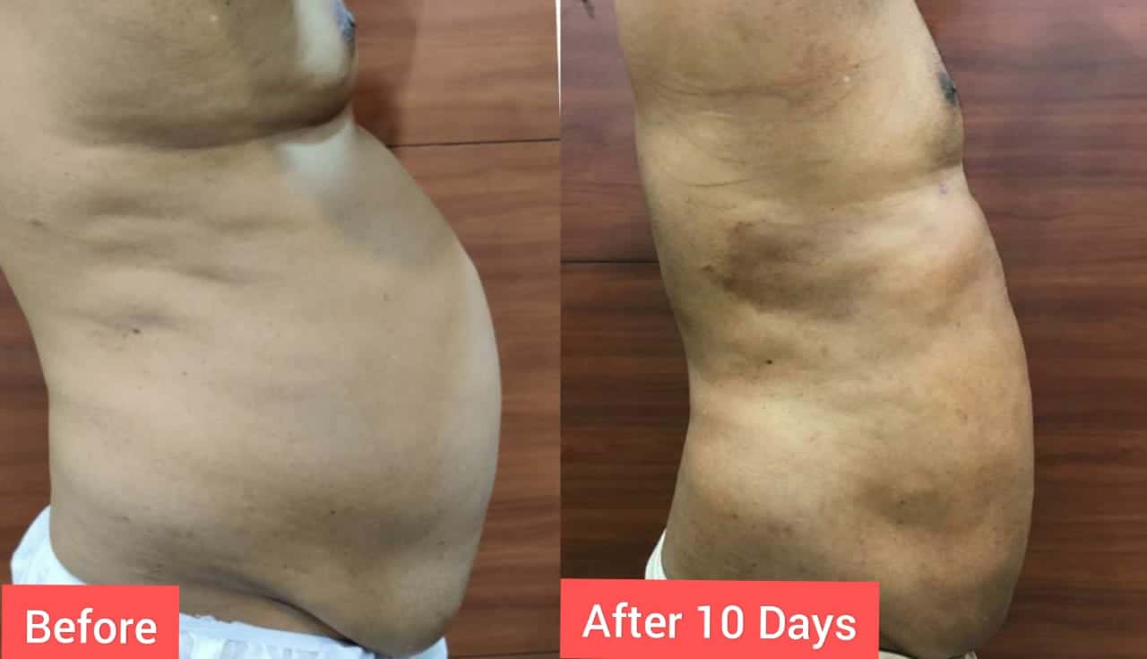 Liposuction Procedures