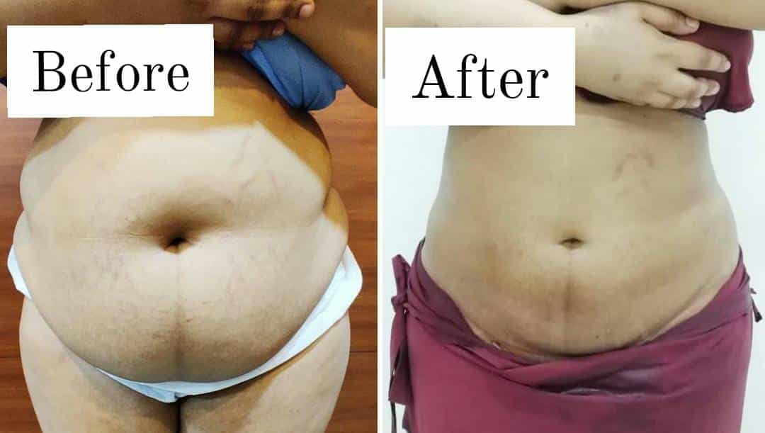 Liposuction Procedures