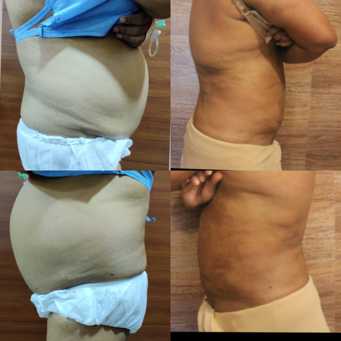 Liposuction Procedures