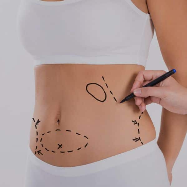 Liposuction