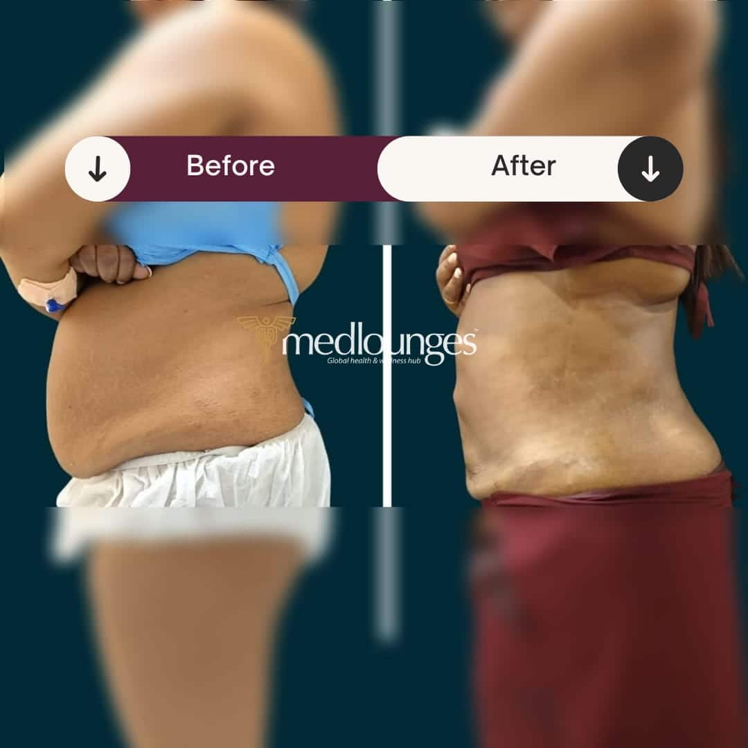 medlounges-liposuction-1