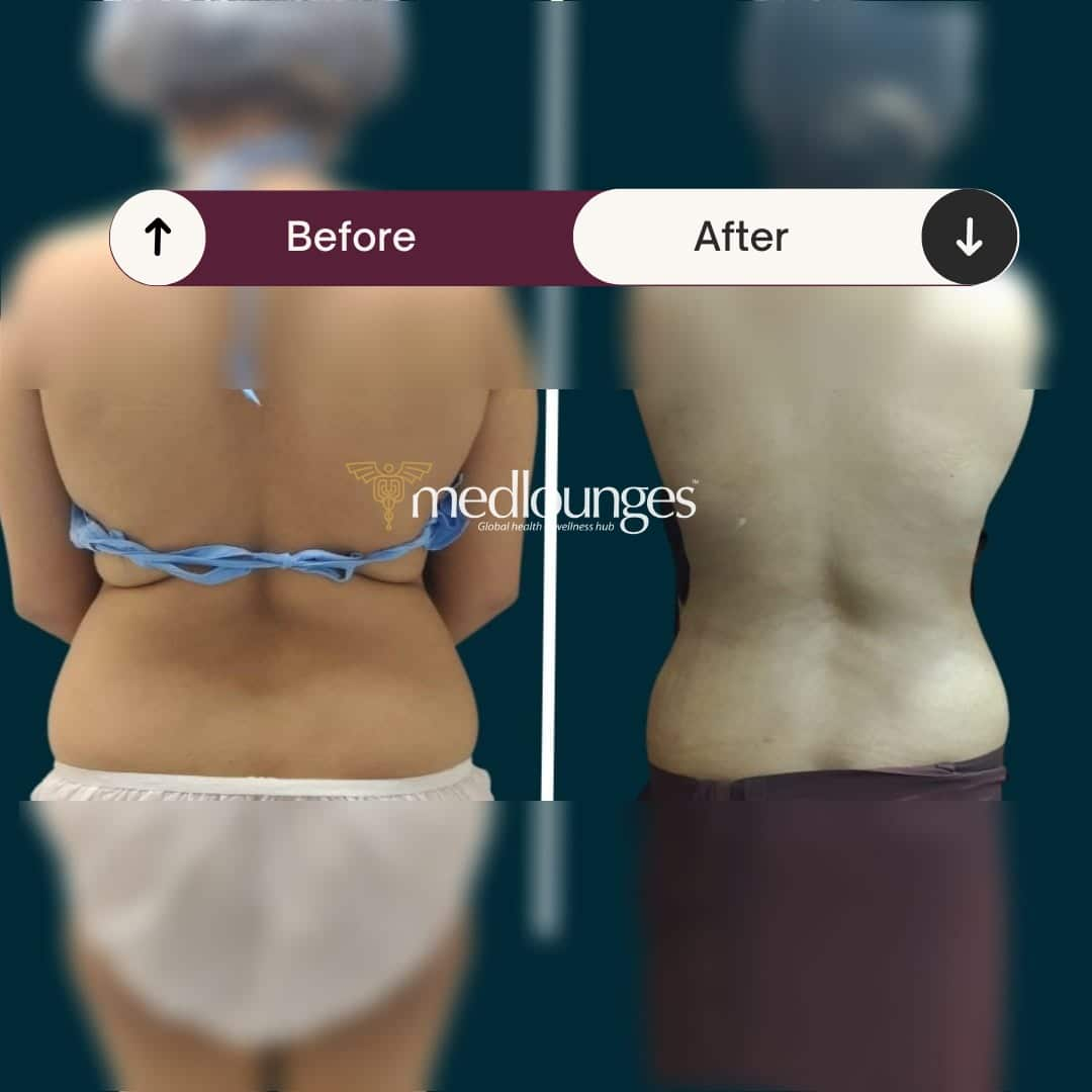 medlounges-liposuction-10