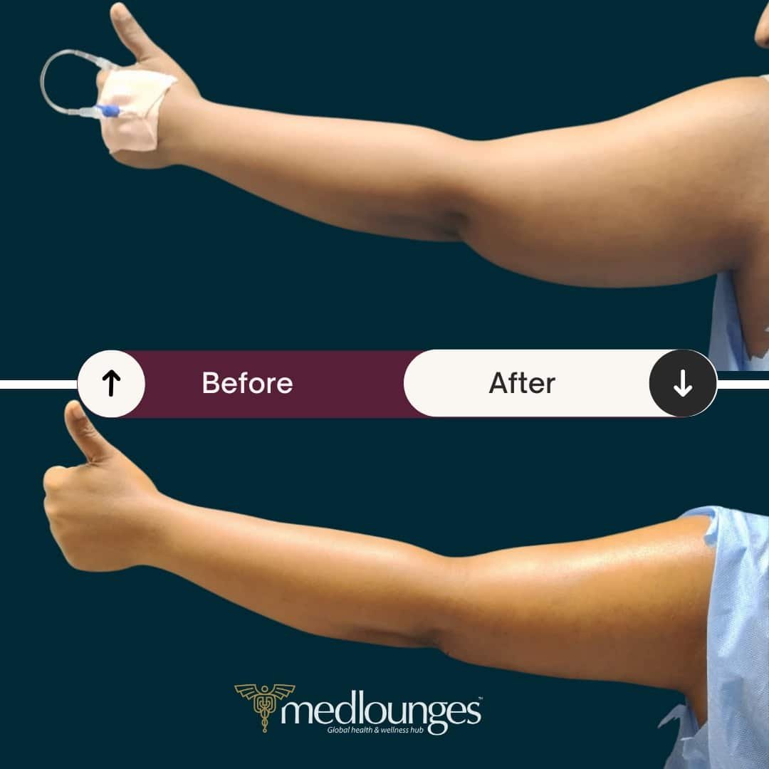 medlounges-liposuction-11