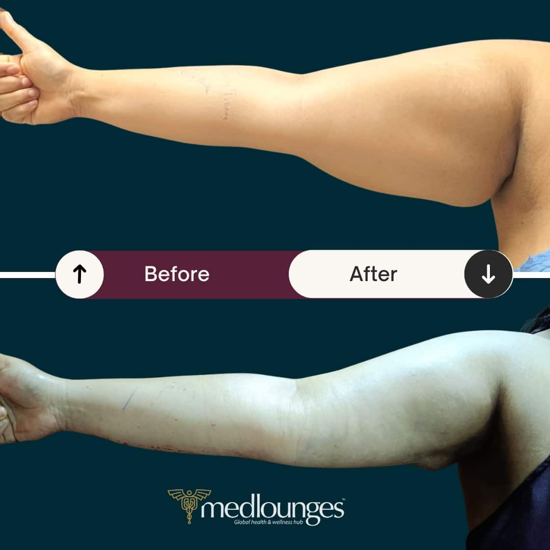 medlounges-liposuction-12