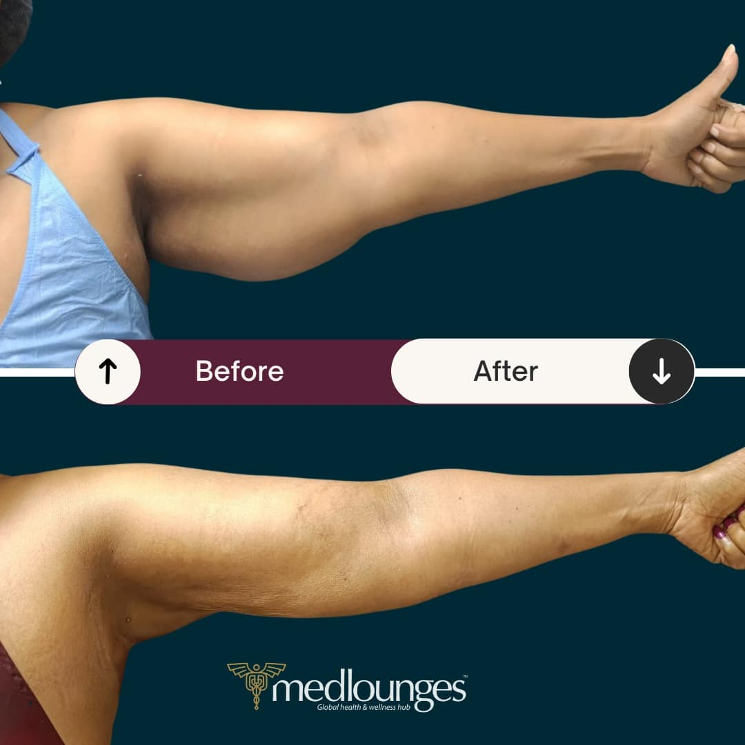 medlounges-liposuction-13