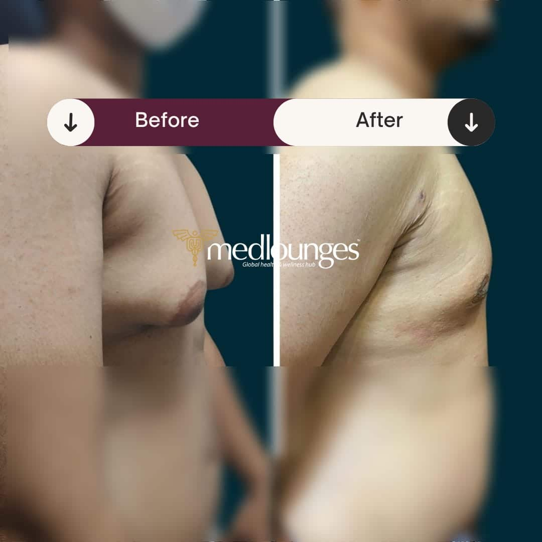 medlounges-liposuction-14