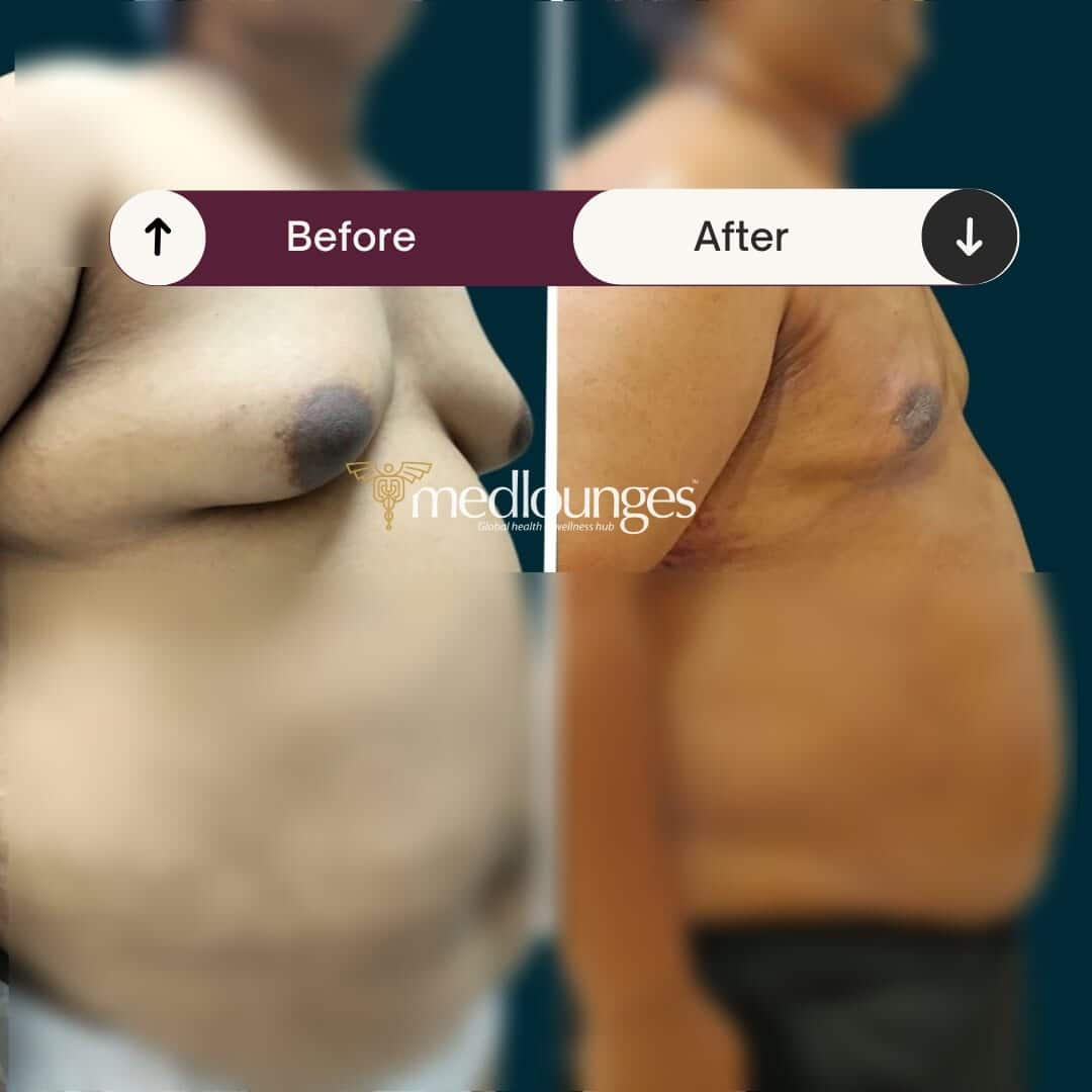 medlounges-liposuction-16