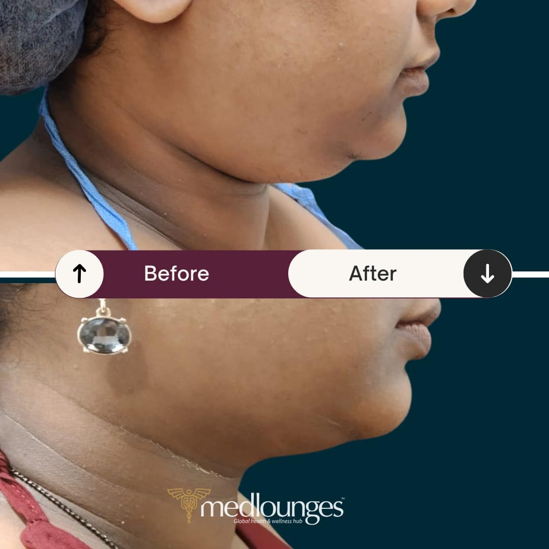 medlounges-liposuction-18