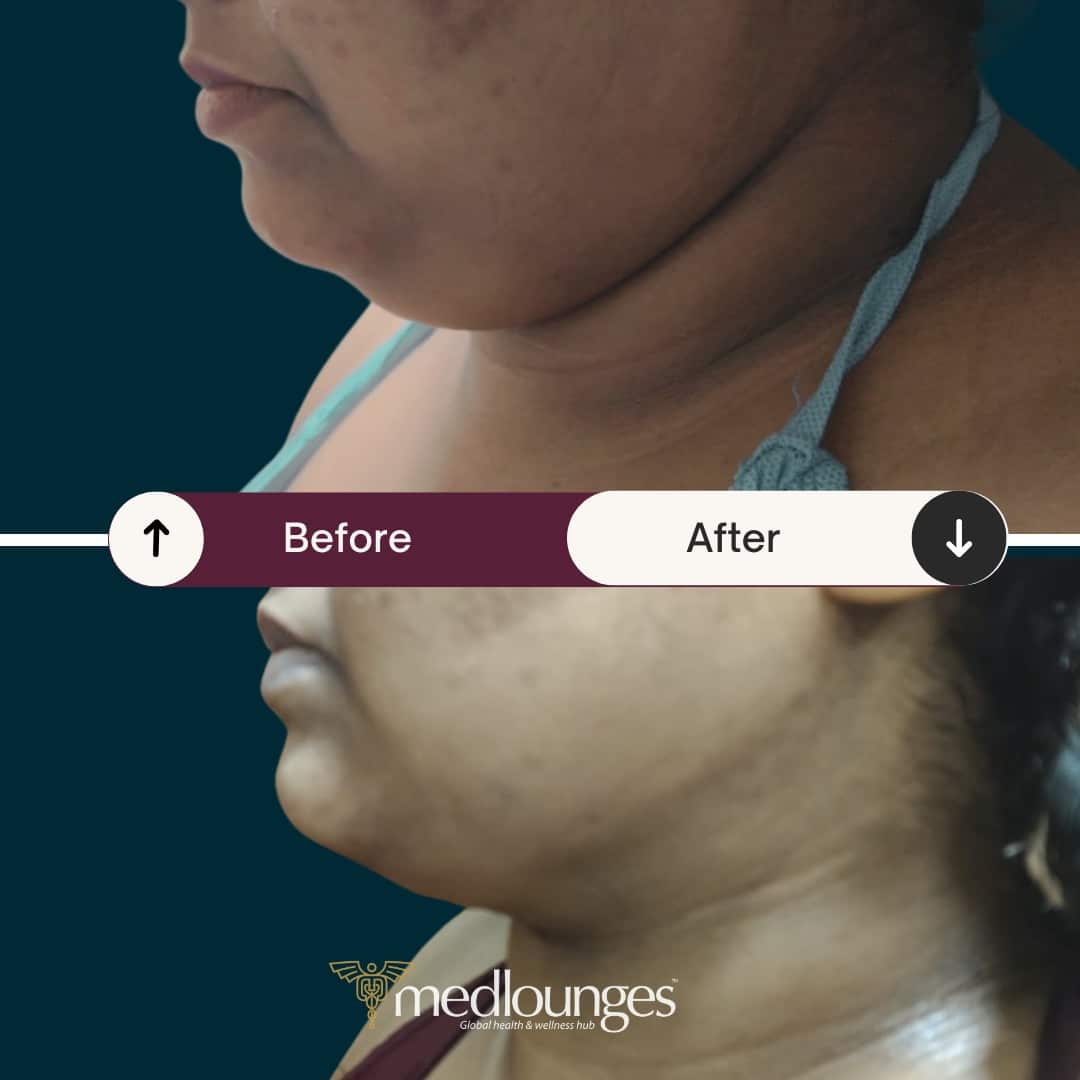 medlounges-liposuction-19