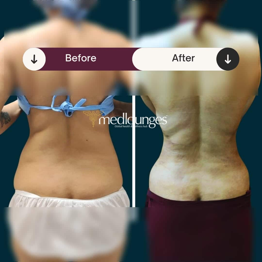 medlounges-liposuction-2