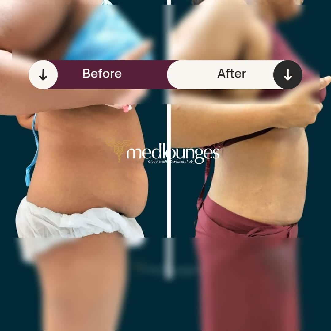 medlounges-liposuction-3