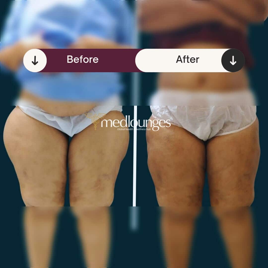medlounges-liposuction-4