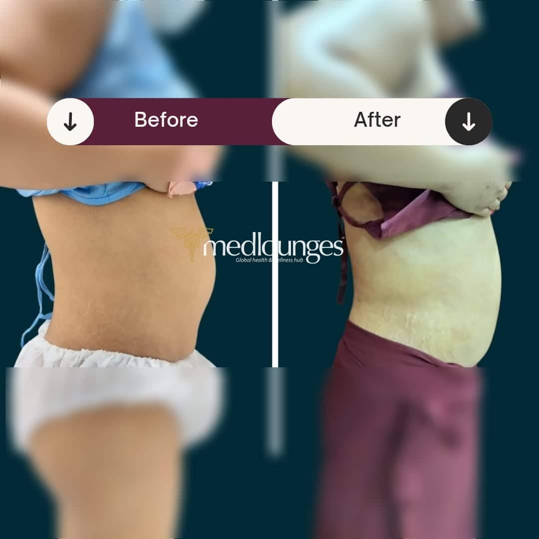 medlounges-liposuction-5