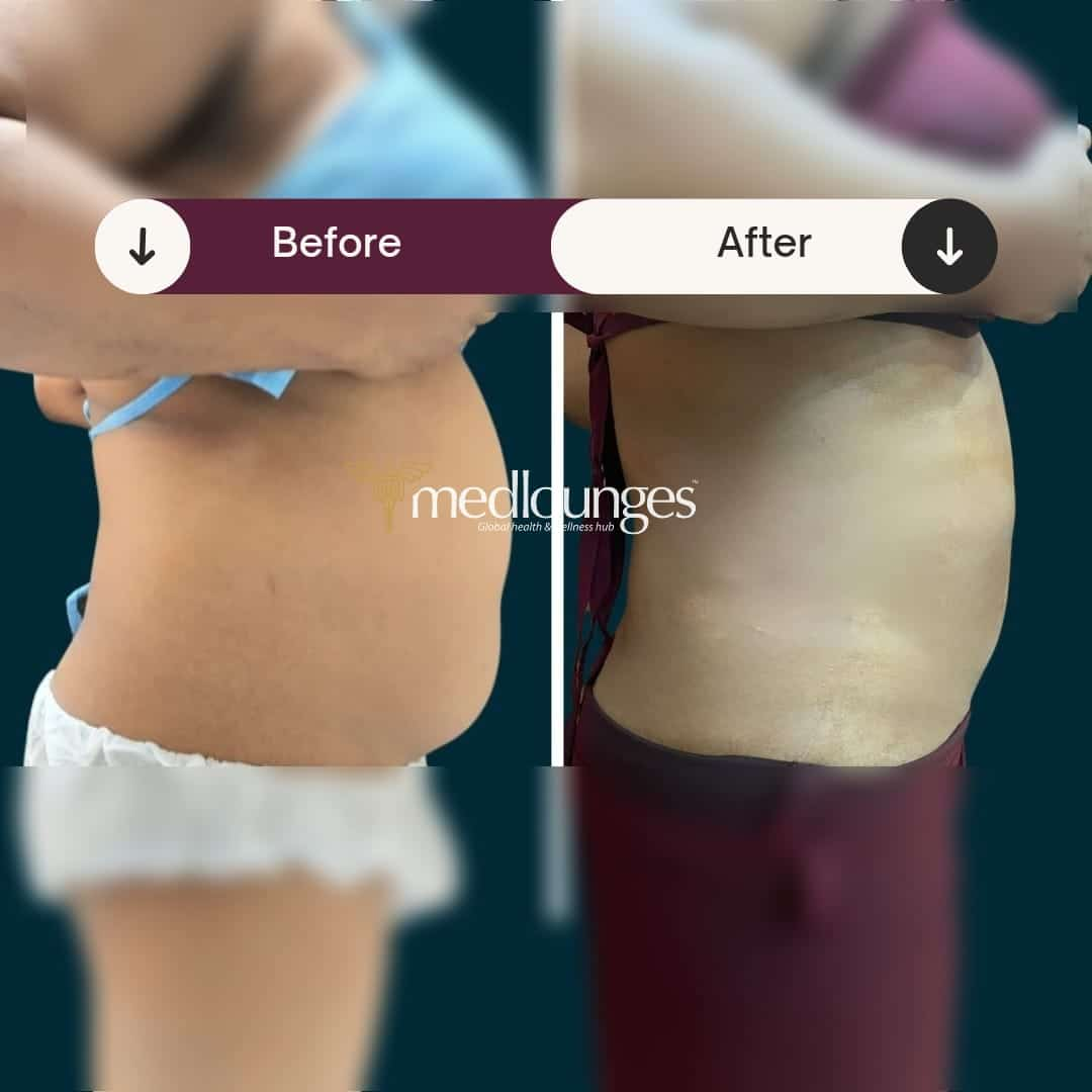 medlounges-liposuction-6