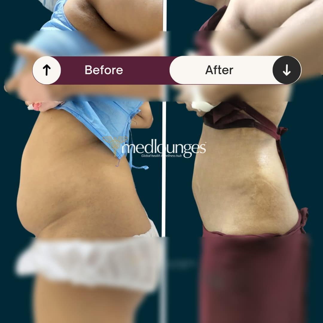 medlounges-liposuction-7