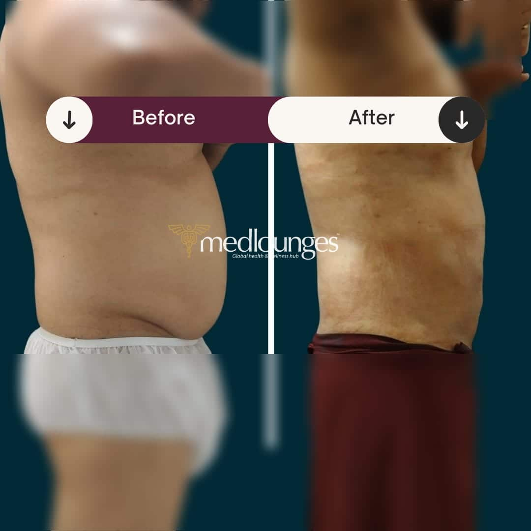 medlounges-liposuction-8