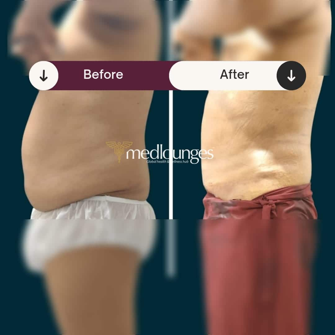 medlounges-liposuction-9