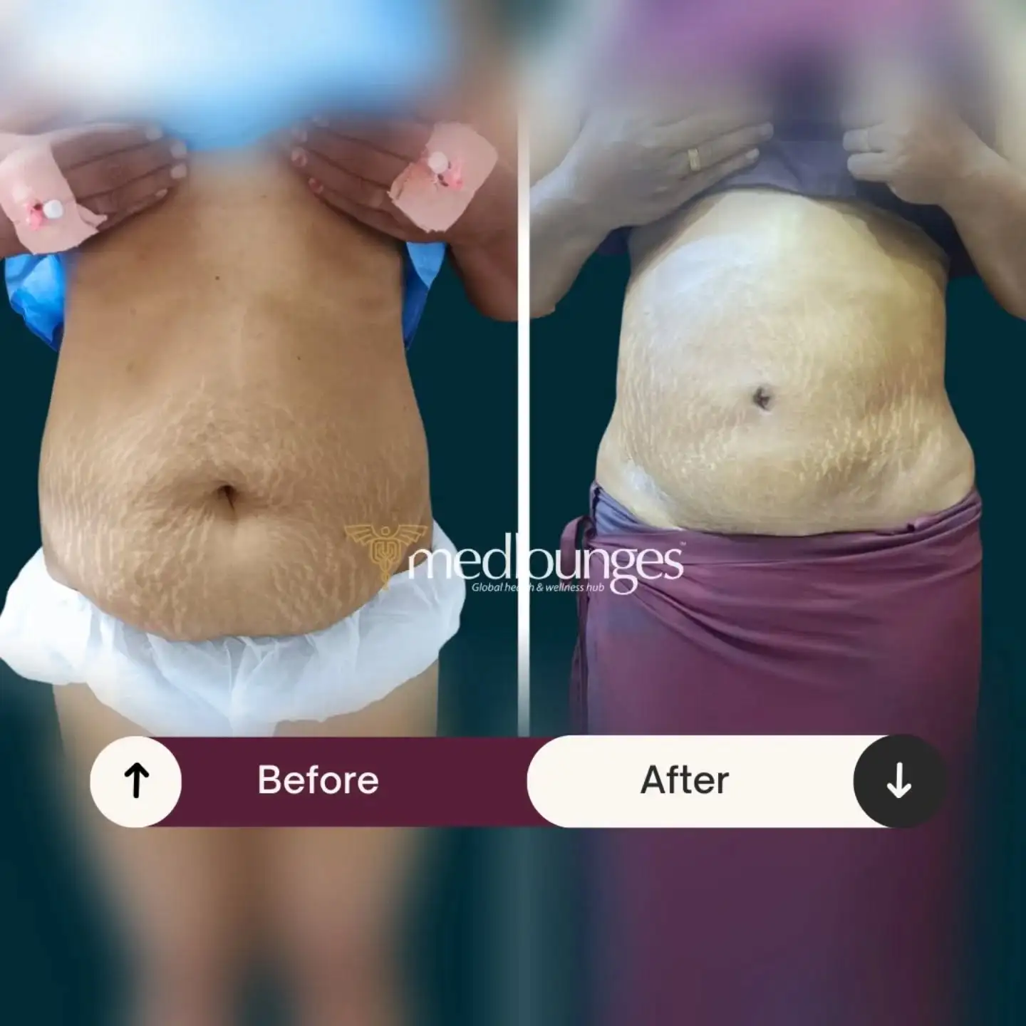 Vaser liposuction