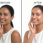 Best Chemical Peel for Indian Skin – Types, Benefits and Results