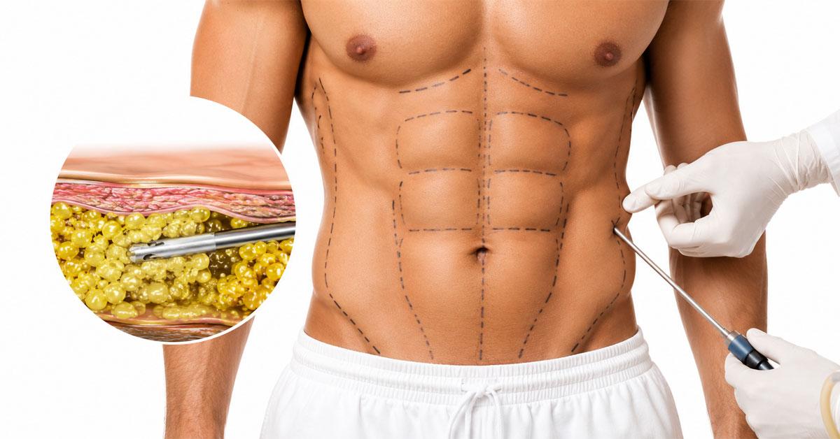 HD liposuction procedure for body contouring and muscle definition