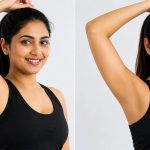 underarm fat removal treatment before and after results