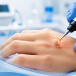 Dermatologist performing wart cauterization treatment for safe wart removal and smooth skin restoration
