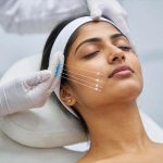 Thread lift procedure showing non-surgical facial lifting using PDO threads