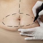 HD liposuction treatment for different body areas including abdomen arms and thighs