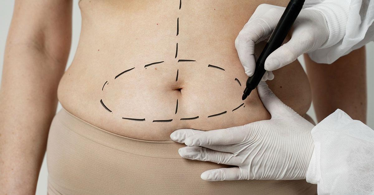 HD liposuction treatment for different body areas including abdomen arms and thighs