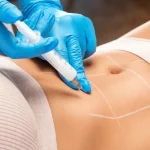Liposuction cost in Kerala 2026 pricing consultation at Medlounges