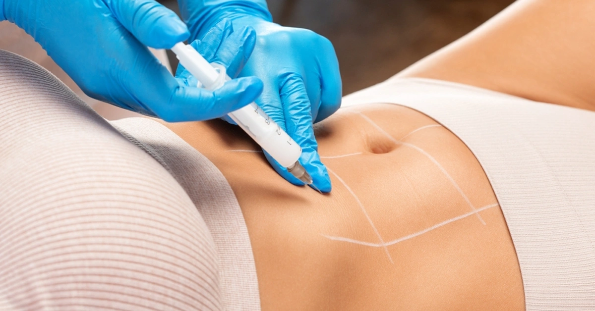 Liposuction cost in Kerala 2026 pricing consultation at Medlounges