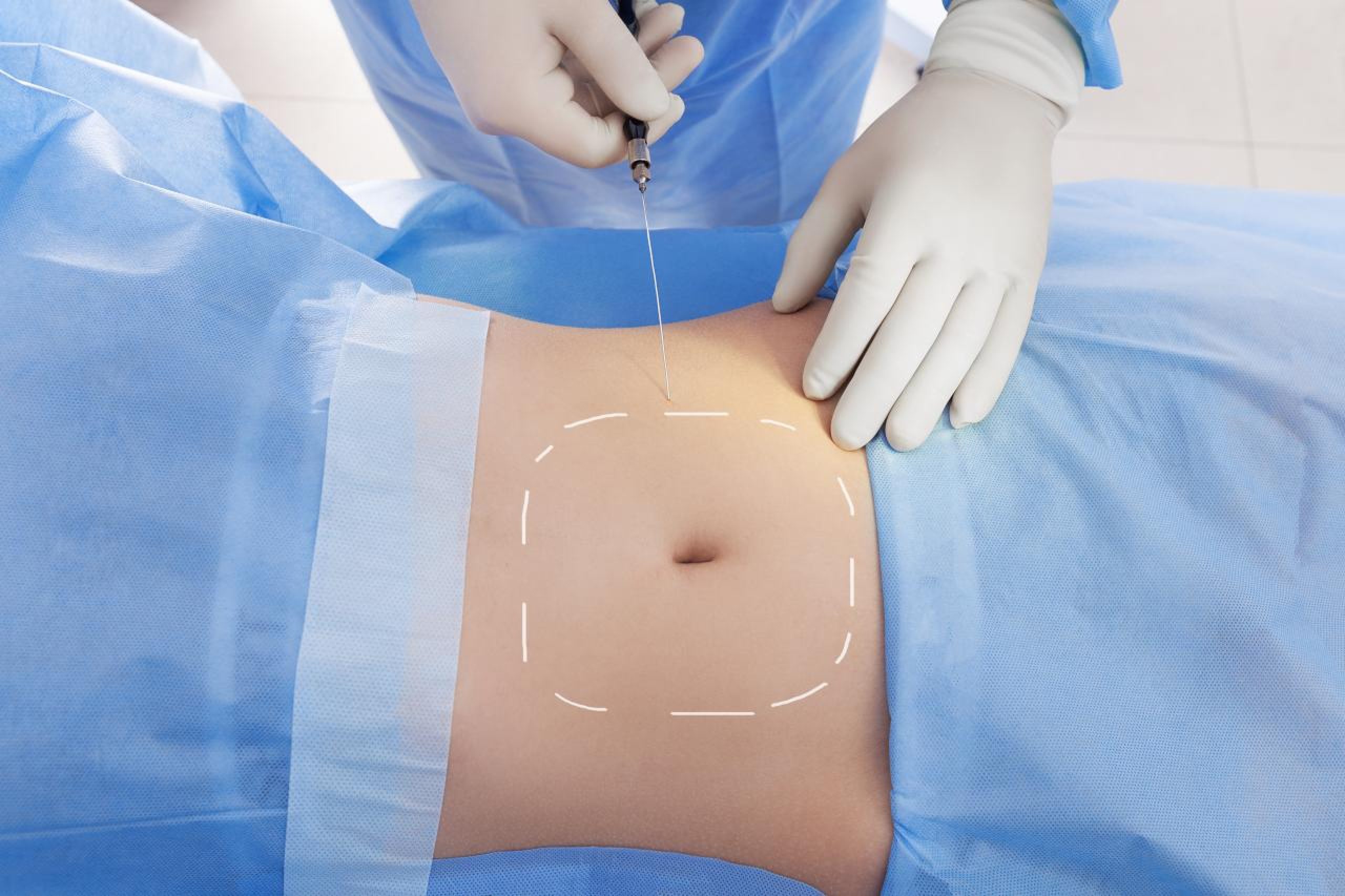 Safest liposuction technique consultation at Medlounges
