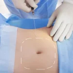 Safest liposuction technique consultation at Medlounges