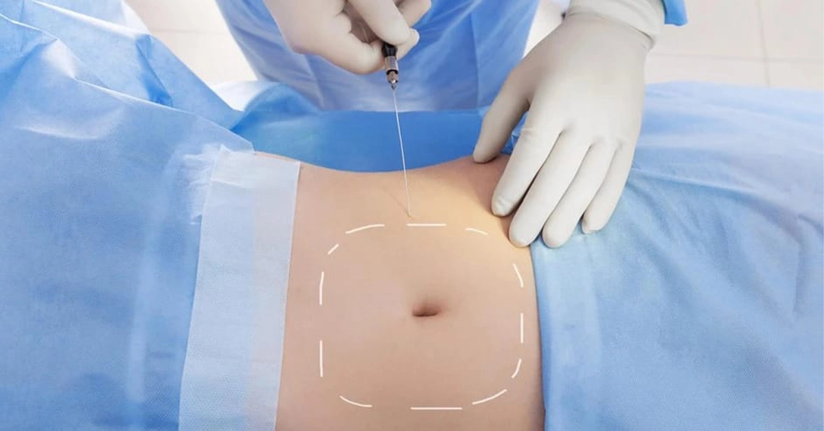 Safest liposuction technique consultation at Medlounges