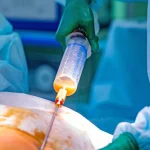 Fat removal during liposuction treatment at Medlounges
